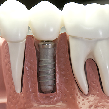 dental implants ogden utah