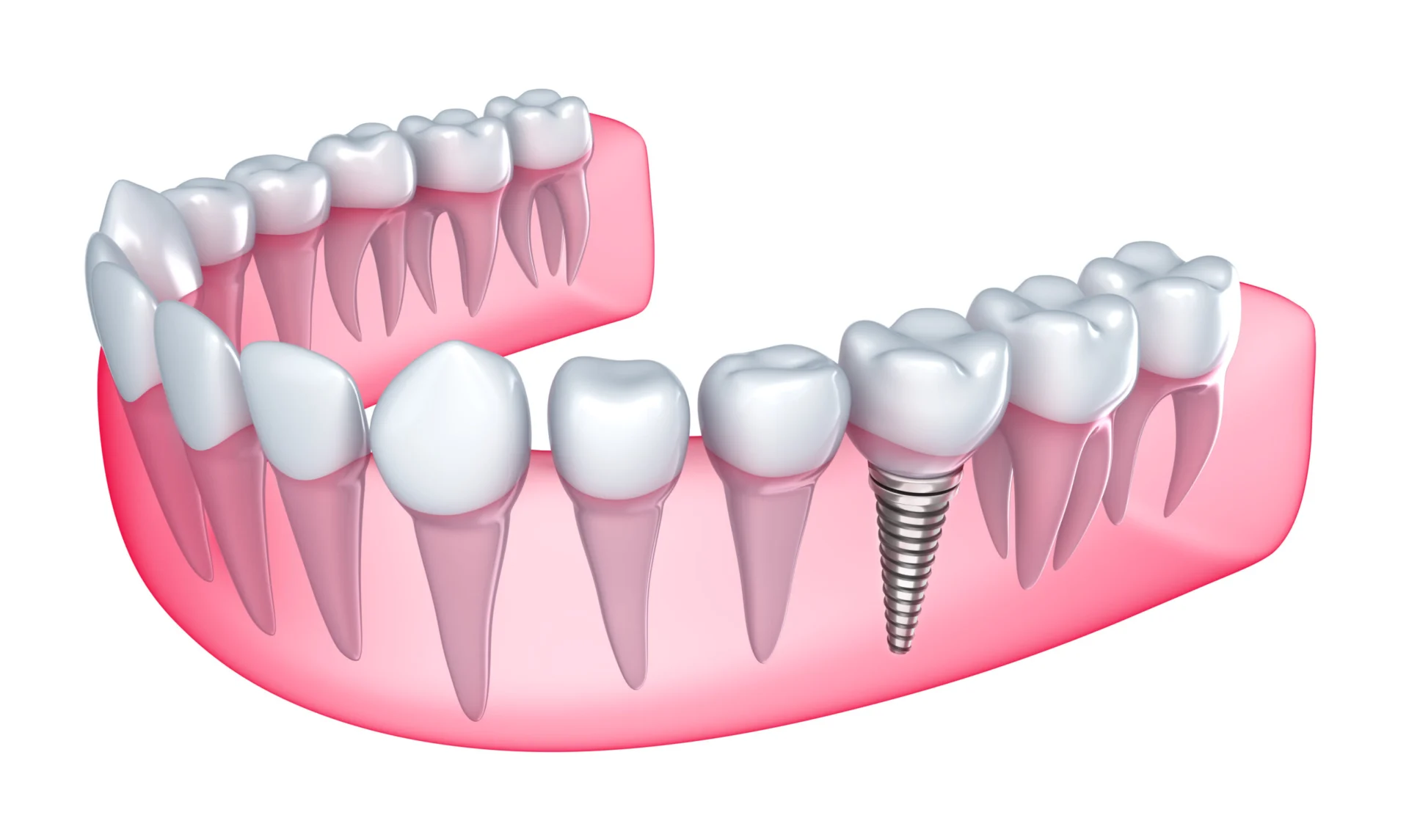 Dental Implants Dental Implants Vector Image North Ogden UT